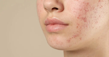 A closeup of a young person with acne