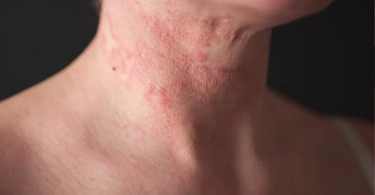 A photo of a woman's neck that shows she has a severe eczema outbreak