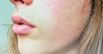 Hormonal-Imbalance-and-Dry-Skin Simple Body