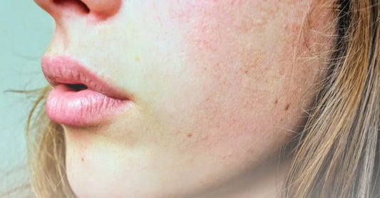 Hormonal-Imbalance-and-Dry-Skin Simple Body