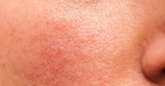 An up close photo of skin that looks mildly irritated by appearing red