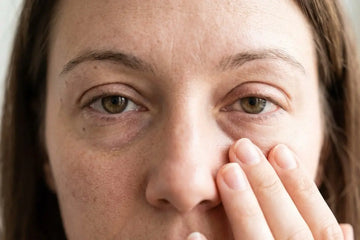 Puffy Eyes Every Morning? Here’s What May Be Causing Them