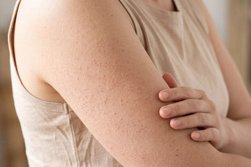Those Little Bumps on Your Arms May Be Keratosis Pilaris