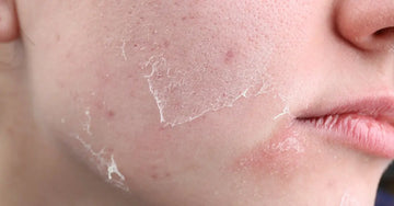 A photo of a young woman with dry, peeling skin