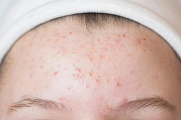 Close-up of a forehead showing clogged pores and small inflammatory breakouts.