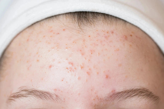 Close-up of a forehead showing clogged pores and small inflammatory breakouts.