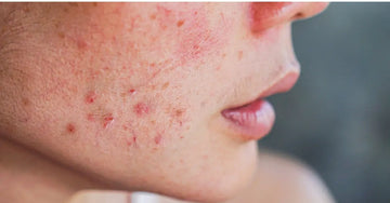 A side profile of a young woman struggling with acne.