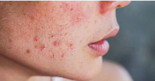 A side profile of a young woman struggling with acne.