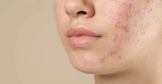 A closeup of a young person with acne