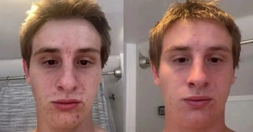 A photo of Zach before and after he used the Simple Body Acne Supporting Kit. The left photo shows Zach suffering from acne, the right photo shows a very clear change.