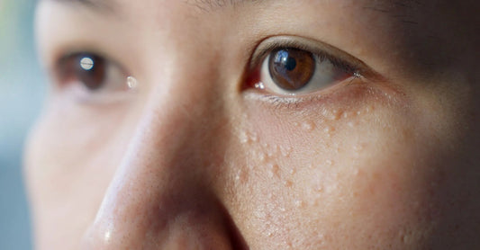 A close up of a womans eye area that shows Keratosis Pilar or chicken skin under the eye area which we use Exfoliate and Glow AHA Tonic to gently remove.