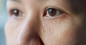 A close up of a womans eye area that shows Keratosis Pilar or chicken skin under the eye area which we use Exfoliate and Glow AHA Tonic to gently remove.