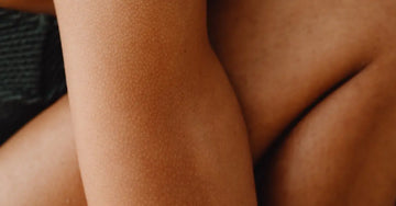 A closeup photo of a woman with Keratosis Pilaris, also known as chicken skin characterized by small red bumps.