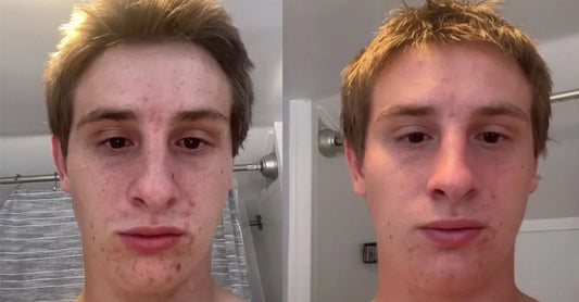 A photo of Zach before and after he used the Simple Body Acne Supporting Kit. The left photo shows Zach suffering from acne, the right photo shows a very clear change.