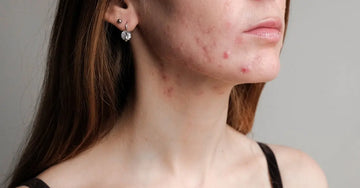 A photo of the bottom half of a young woman who is showing signs of hormonal acne.