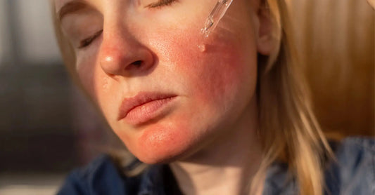 A woman with rosacea applies Simple Body Pomegranate Facial Serum as a natural skin supporting ingredient for a damaged skin barrier with a blurred background.