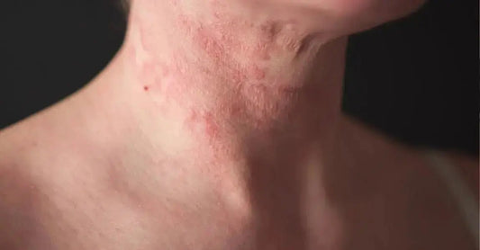 A photo of a woman's neck that shows she has a severe eczema outbreak