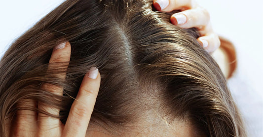 A close up of a woman's scalp showing visible dandruff