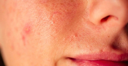 Close-up of facial skin showing redness and irritation associated with a compromised skin barrier.