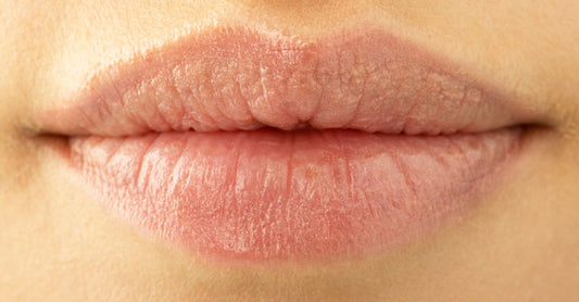 A close up image of dry, chapped lips