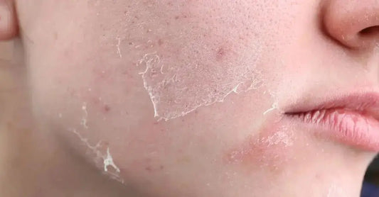 A photo of a young woman with dry, peeling skin