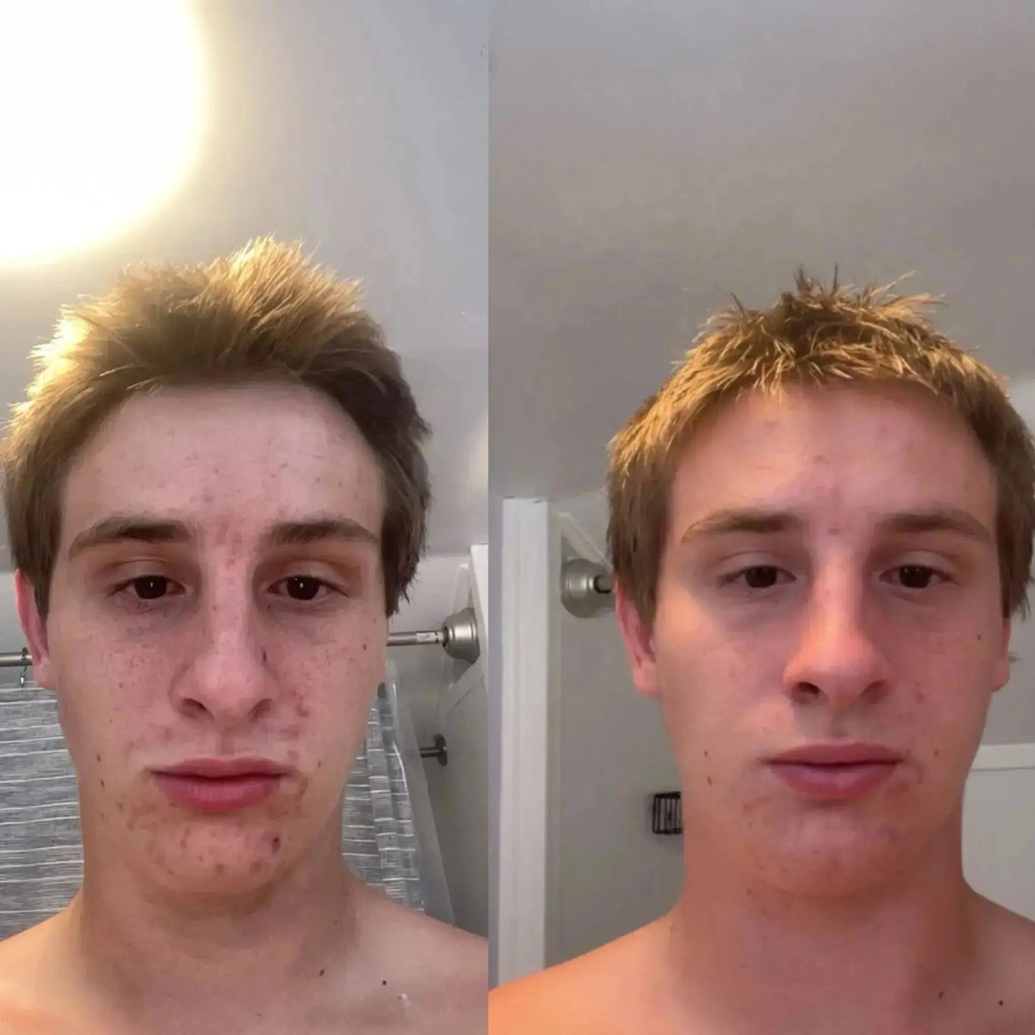 Skincare for Acne-Prone Skin