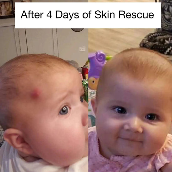 Before and after comparison of a baby's skin rash with text 'After 4 Days of Skin Rescue' showing it completely cleared up.
