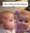 Before and after comparison of a baby's skin rash with text 'After 4 Days of Skin Rescue' showing it completely cleared up.