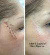Before and after comparison of a scar on a person's face after 6 days of using Simple Body Herbal Skin Rescue treatment.