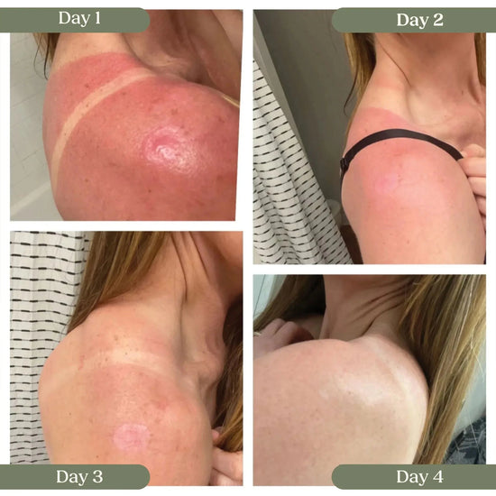 A woman showing her progression of a really bad sunburn on day 1, then using Simple Body Beauty Balm, day two showing redness but significantly better, day three showing little to no redness and day 4 showing no redness.