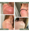A woman showing her progression of a really bad sunburn on day 1, then using Simple Body Beauty Balm, day two showing redness but significantly better, day three showing little to no redness and day 4 showing no redness.