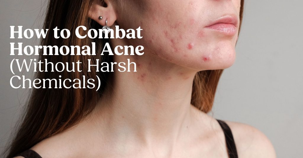 An image of a womans face demonstrating hormonal acne along the jawline