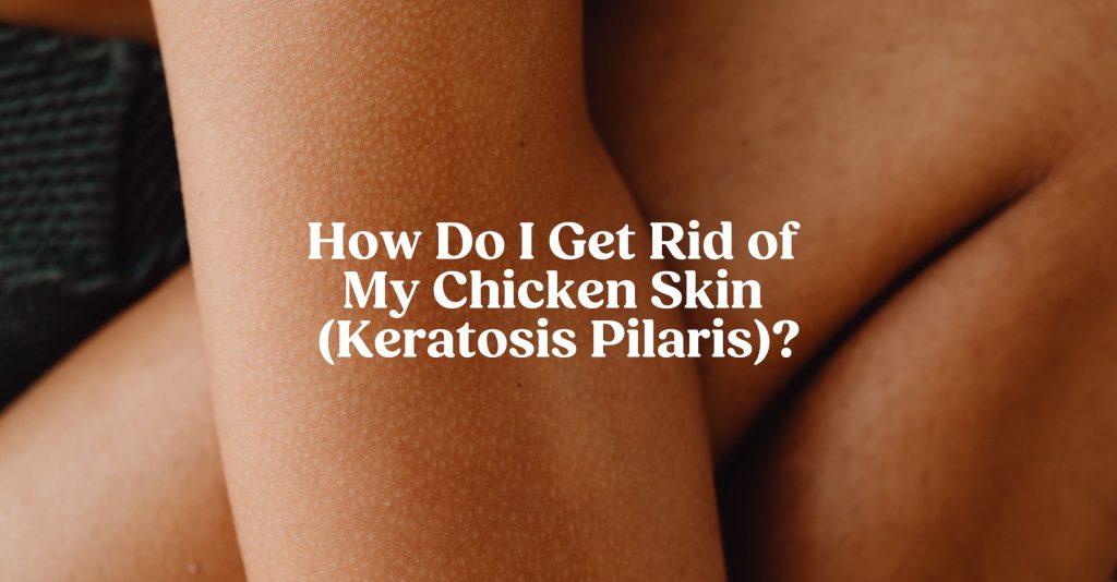A close up image of an arm with small white bumps illustrating Keritosis pilaris