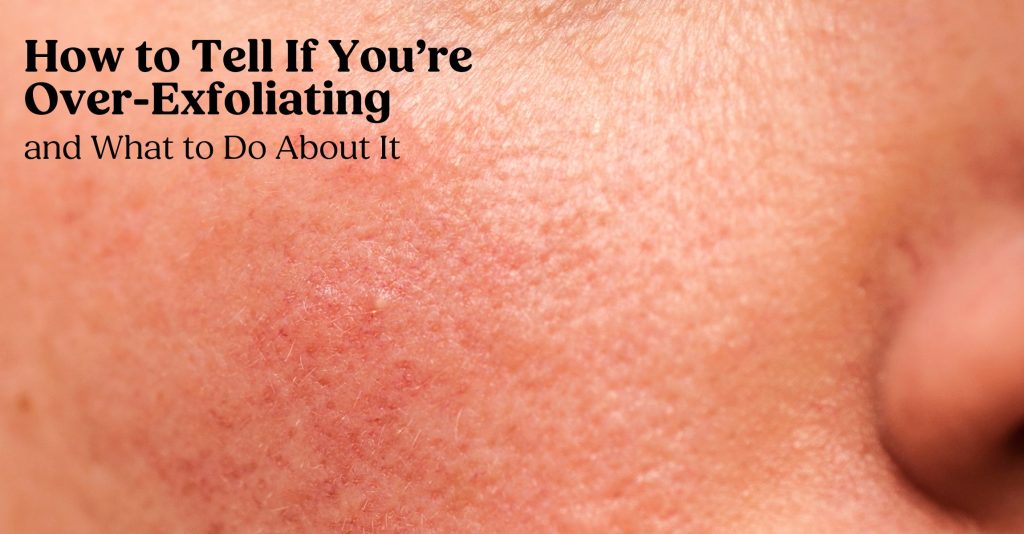 A close-up image of red, irritated skin.