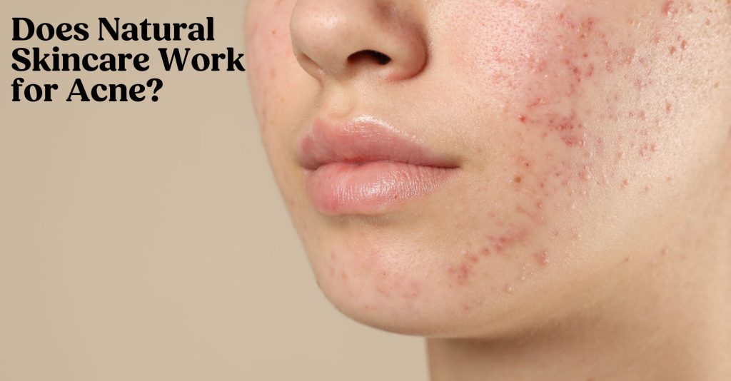 A photo of a young women from the nose to the chin showing visible acne on her cheek and jawline.
